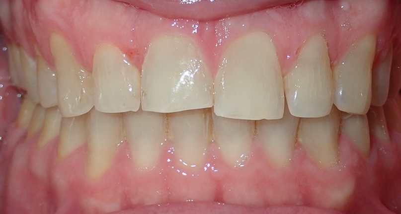 Before